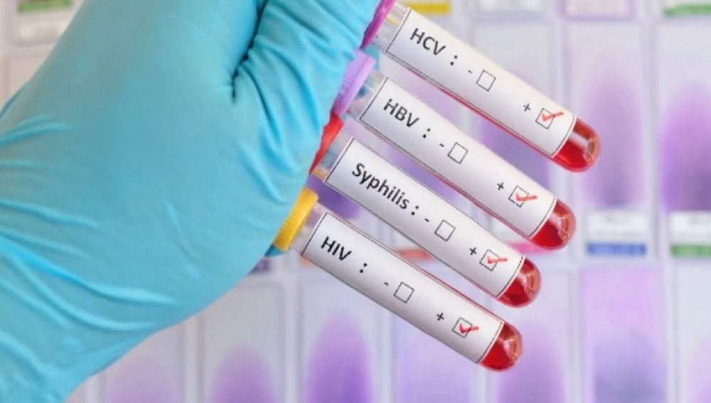 Misiones registra un 41% de diagnóstico tardio de VIH y sifilis